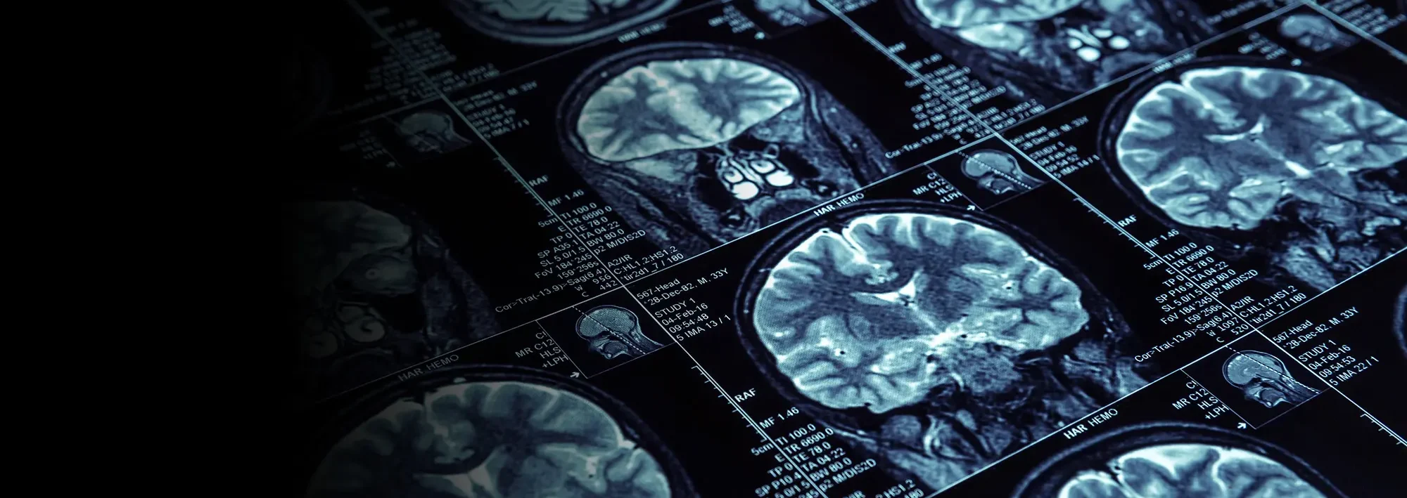 Photo of MRI brain scan