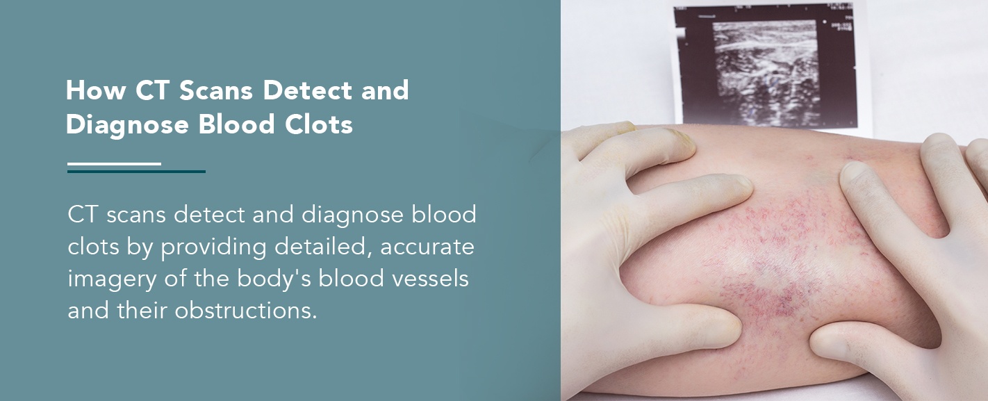 How CT Scans Detect and Diagnose Blood Clots