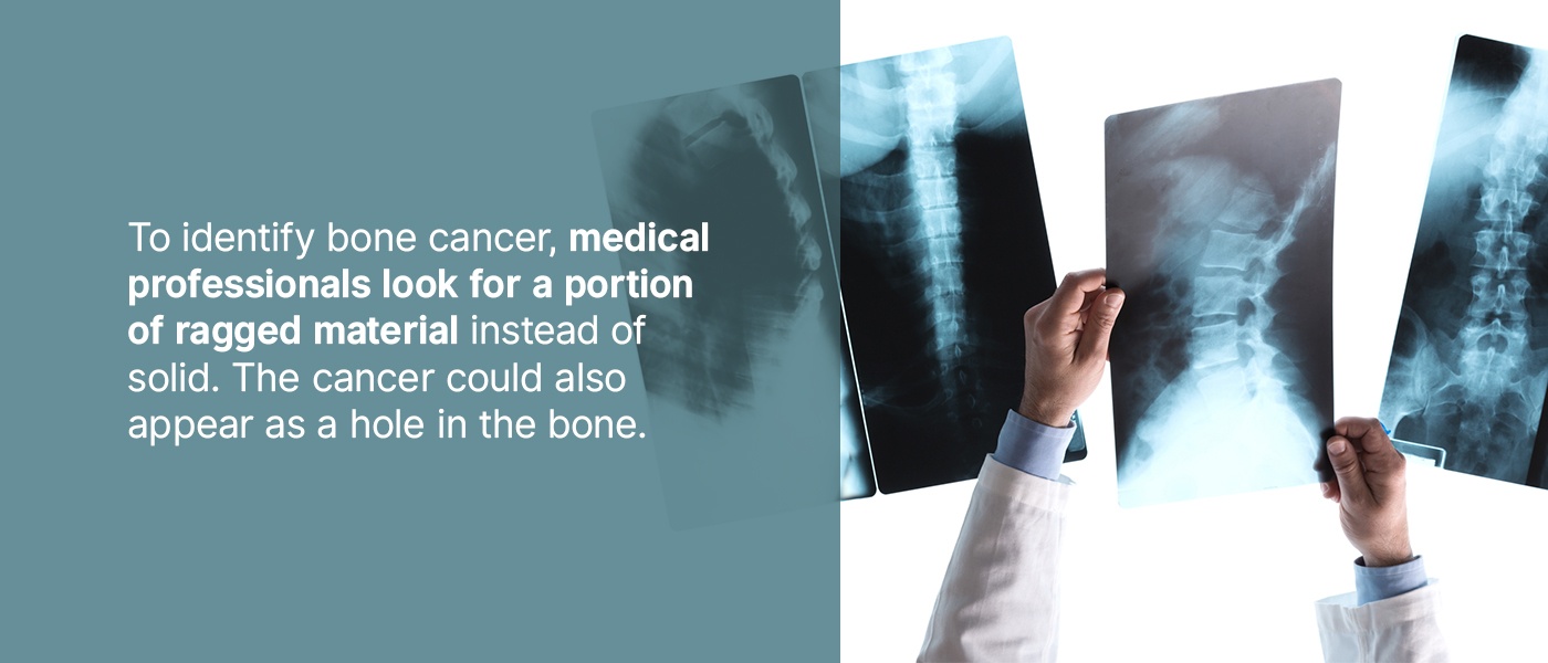 identifying bone cancer on x-ray