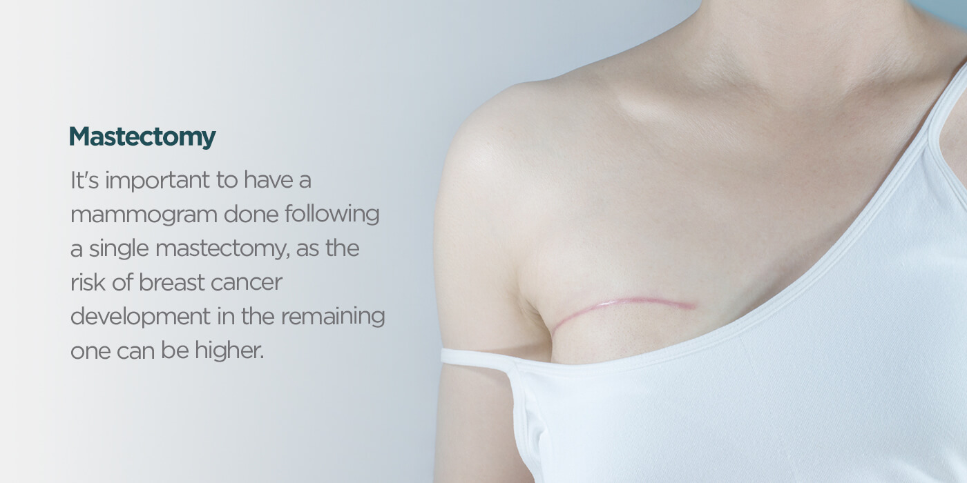 mastectomy