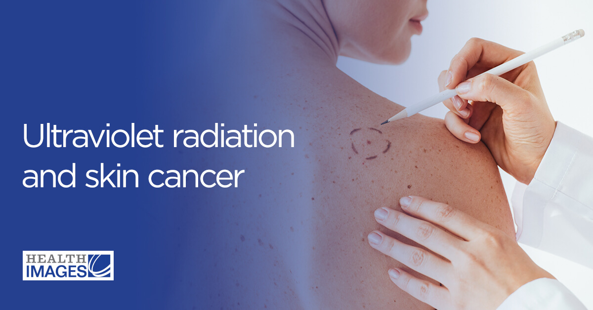 Ultraviolet radiation and skin cancer