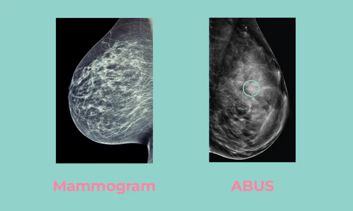 Image scans showing the difference between a mammography image and an ABUS image.
